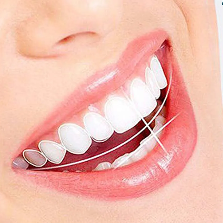 SMILEPRO® – Carillas para Dientes | Oferta 2 por 1