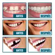 SMILEPRO® – Carillas para Dientes | Oferta 2 por 1