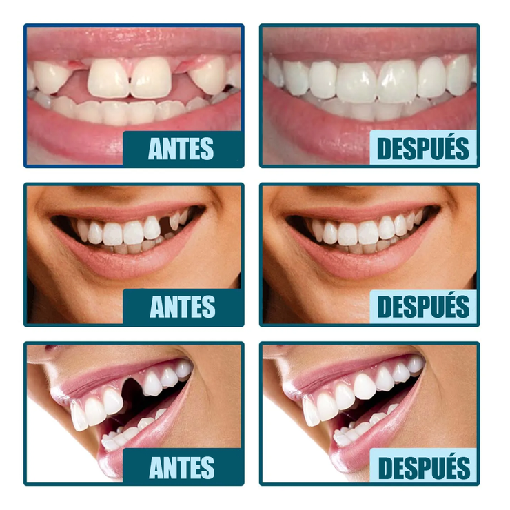 SMILEPRO® – Carillas para Dientes | Oferta 2 por 1