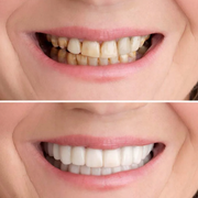 SMILEPRO® – Carillas para Dientes | Oferta 2 por 1