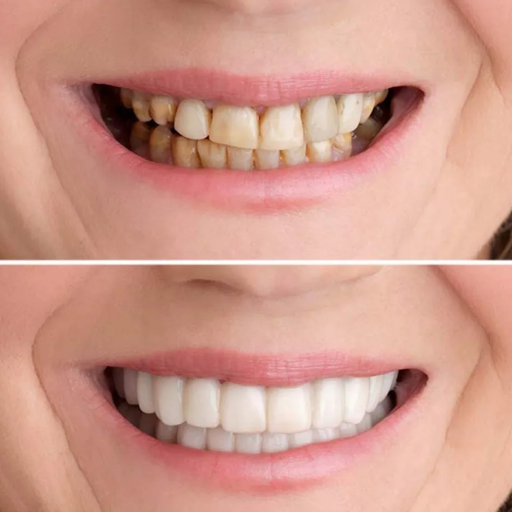 SMILEPRO® – Carillas para Dientes | Oferta 2 por 1